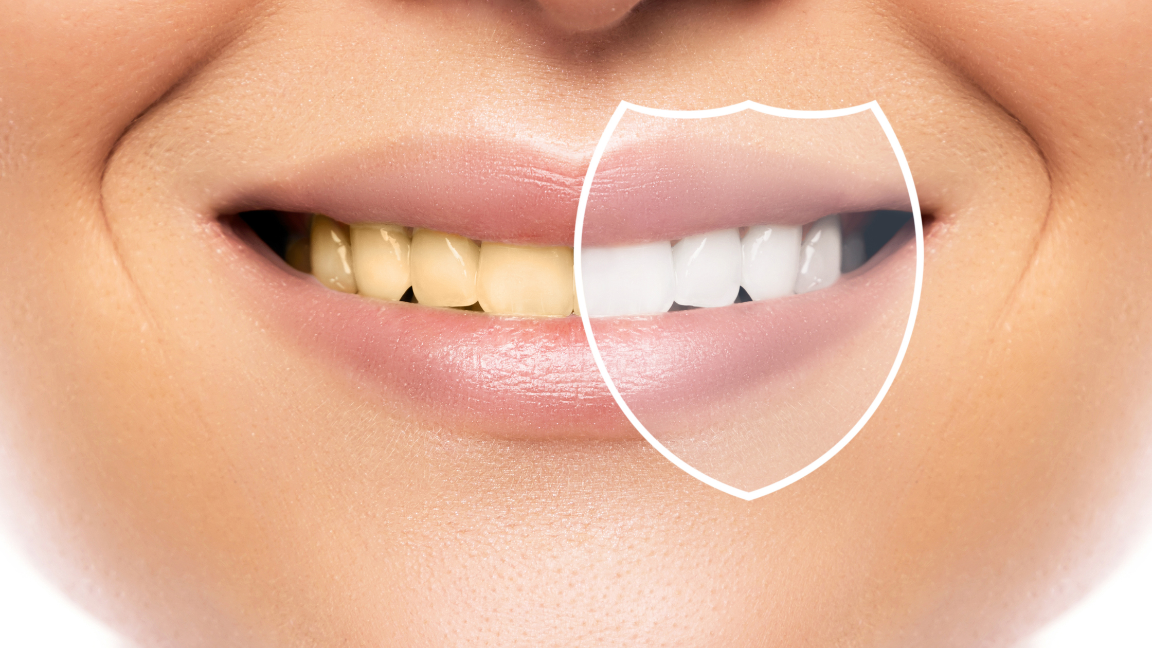 Is It Good to Bleach Your Teeth? Benefits, Risks, Cost & Dentist Advice in Gachibowli, Hyderabad